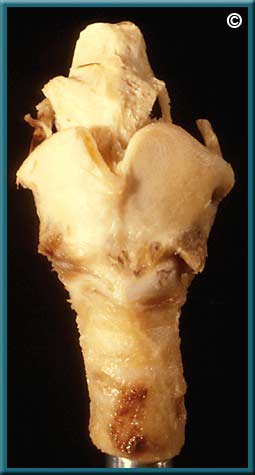 Larynx Part 1 - Slide 46