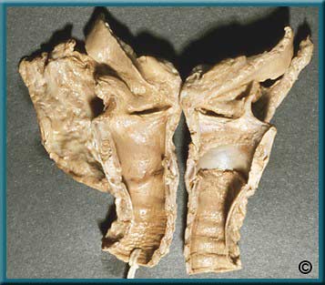 Larynx Part 1 - Slide 55