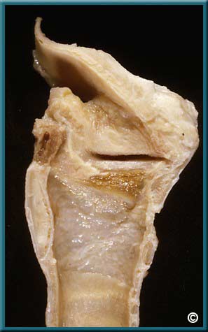 Larynx Part 1 - Slide 56