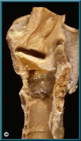 Larynx Part 1 - Slide 58