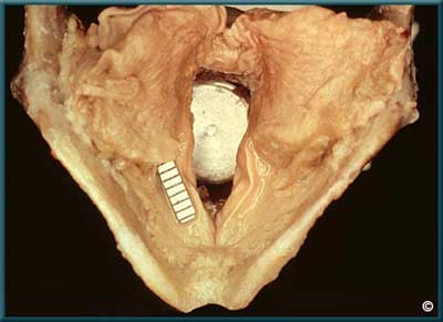 Larynx 2 - Slide 20